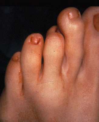 БОЛЕЗНЬ КЕЛЛЕРА