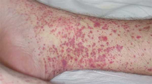 Геморрагический васкулит