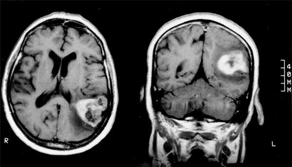 обширные поражения