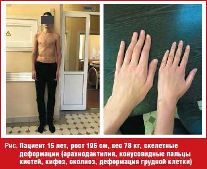 Пациент 15 лет, рост 196 см, вес 78 кг, скелетные деформации