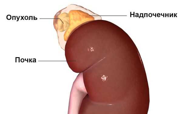 Опухоль надпочечника