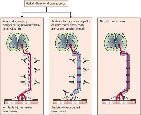 Подтипы синдрома Гийена — Барре
