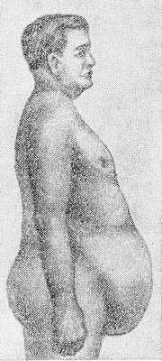 Рис. 2. Внешний вид мужчины с приобретенным спланхноптозом.