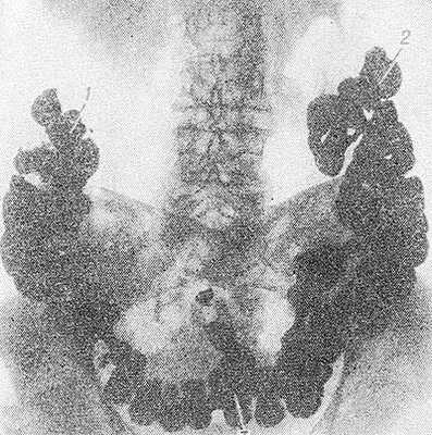 Рис. 3. Рентгенограмма брюшной полости больного с колоптозом (прямая проекция) после перорального контрастирования толстой кишки: печеночный (1) и селезеночный (2) изгибы ободочной кишки расположены низко, поперечная ободочная кишка (3) провисает в малый таз.