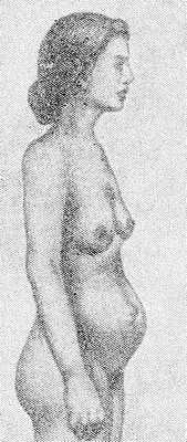 Рис. 1. Внешний вид женщины с конституциональным спланхноптозом.
