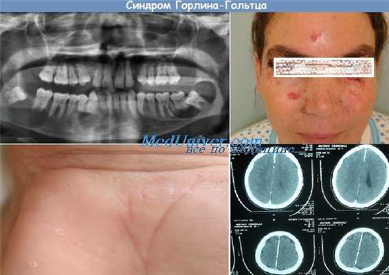 Синдром Горлина-Гольтца (Gorlin-Goltz)
