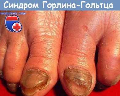 синдром Гольтца-Горлина