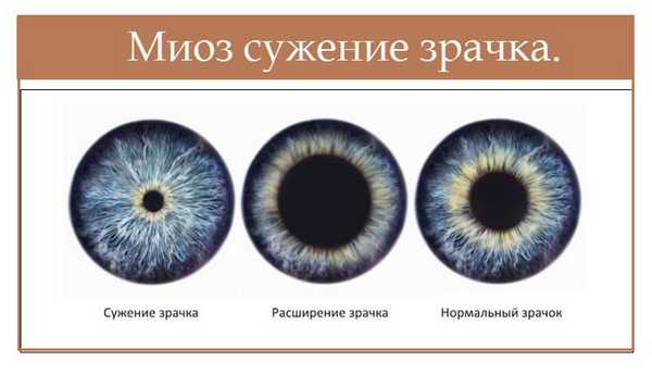 миоз зрачка