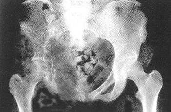 В статье рассмотрены основные признаки и симптомы, диагностирование, разные методы лечения и прогнозы одного из заболеваний опорно-двигательного аппарата (название от фамилии впервые описавшего ее в 1954 году доктора Горхема).