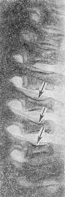 Рис. 5. Рентгенограмма грудного отдела позвоночника ребенка 10 лет при болезни Гоше: выражена бревиплатиспондилия (уплощение тел позвонков — указано стрелками).