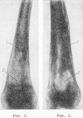 Рис. 2 и 3. Рентгенограммы бедер при болезни Гоше. Рис. 2. Булавовидное расширение метадиафиза бедренной кости в нижней трети с выраженными внутрикостными обызвествлениями (1) и широкопетлистой костной структурой (2). Рис.З. Расширение метадиафиза бедренной кости с уплотнением (1) и обширным участком деструкции (2).