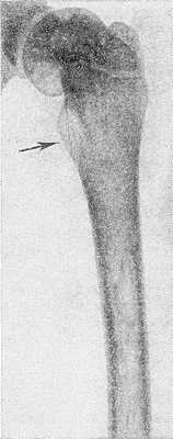 Рис. 4. Рентгенограмма бедра ребенка 10 лет при болезни Гоше: выражено утолщение шейки бедренной кости (указано стрелкой).