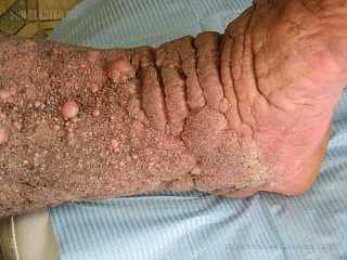 Карциноидный папилломатоз кожи Готтрона