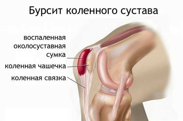 Препателлярный бурсит.jpg