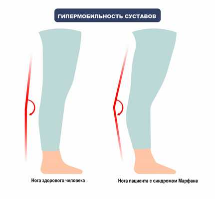 Гипермобильность суставов.jpg