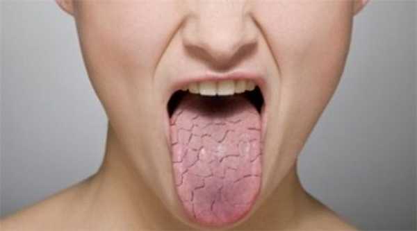 Синдром Шегрена