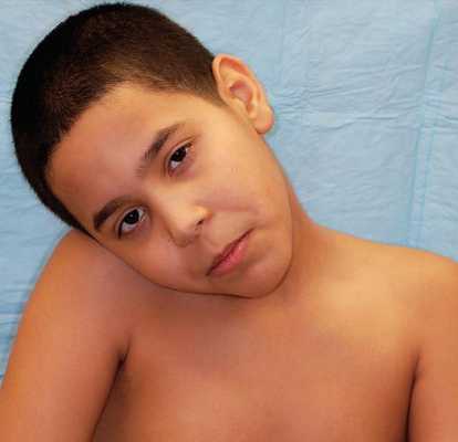 Болезнь Гризеля у ребенка