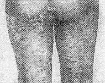 Высыпания на коже при лихеноидном пурпурозном и пигментном ангиодермите Гужеро — Блюма.