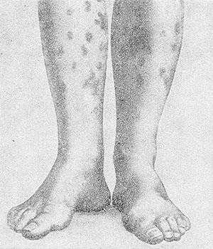 Рис. 1. Геморрагический лейкокластический микробид Мишера — Шторка. Эритематозно-геморрагические пятна.