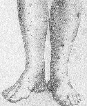 Рис. 2. Узелково-некротический васкулит (Вертера — Дюмлинга).