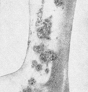 Рис. 3. Аллергический артериолит Руитера (полиморфно-узелковый тип). Узелки, эрозии с геморрагическими корками, гиперпигментация,