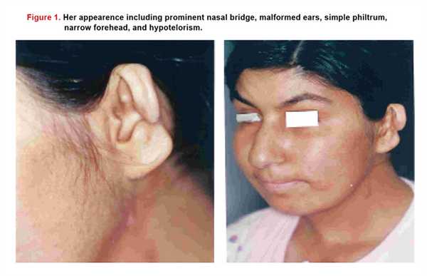 Синдром ивемарка фото