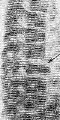 Рентгенограмма грудного отдела позвоночника в боковой проекции. Остеохондропатия тела позвонка (болезнь Кальве): стрелкой указан пораженный позвонок.