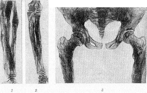 Рис. 2. Рентгенограммы костей голени (1), предплечья (2), таза и верхней трети бедер (3) больного системным гиперостозом: длинные трубчатые кости цилиндрически и булавовидно утолщены, корковый слой неплотный, резко утолщенный, имеет неравномерную пятнистую структуру с неровными контурами; кости таза утолщены.