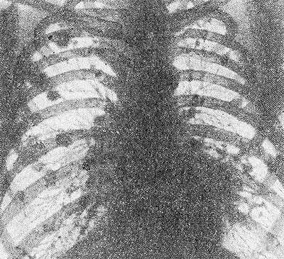 Рентгенограмма грудной клетки больного с синдромом Каплана: видны множественные затемнения округлой формы.