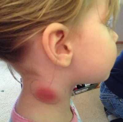 Увеличение лимфоузлов у ребенка