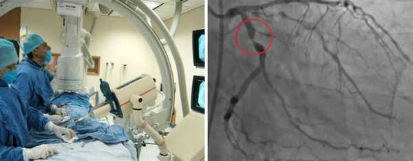 Коронография, стеноз