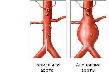 Аневризма аорты