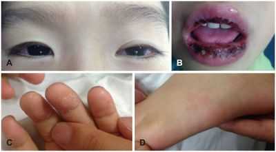 Проявления болезни Кавасаки