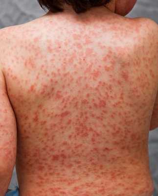 Сыпь на коже у ребенка