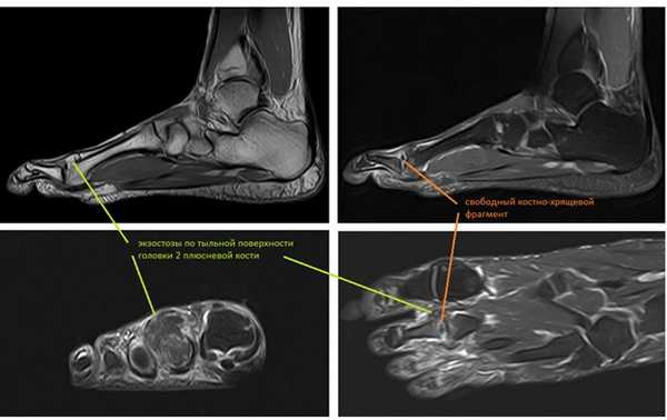 Болезнь Келлера 2 МРТ