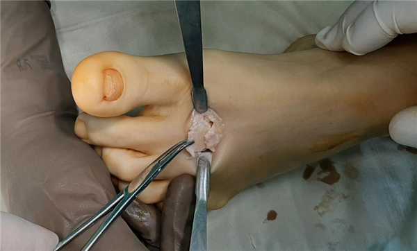 келлер 2 остеотомия