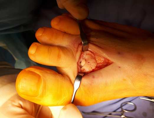 Болезнь келлера 2 операция