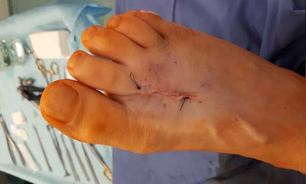 Болезнь Келлера 2 после операции