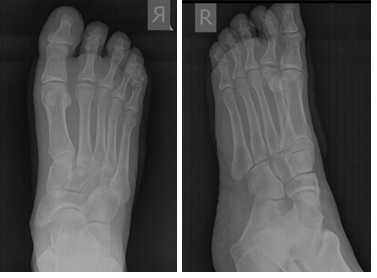 Келлер 2 рентген после операции