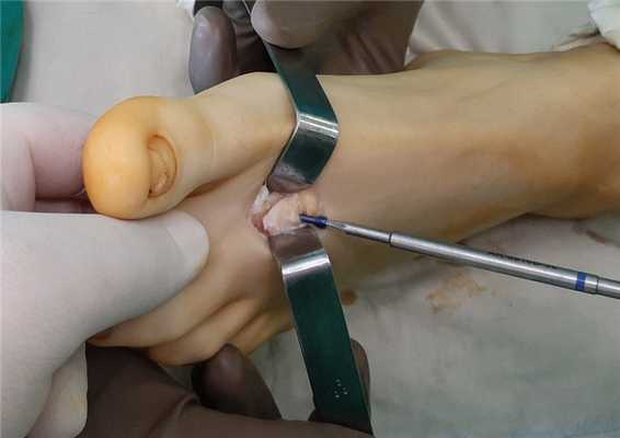 келлер 2 фиксация остеотомии винтом