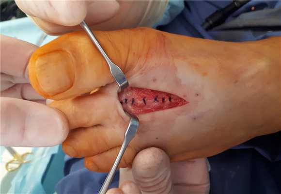 Болезнь Келлера 2 этапы операции