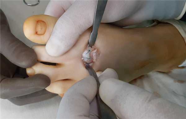 фиксация суставного хряща трансоссальным швом