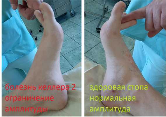 келлер 2 симптомы