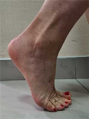 болезнь келлера после операции