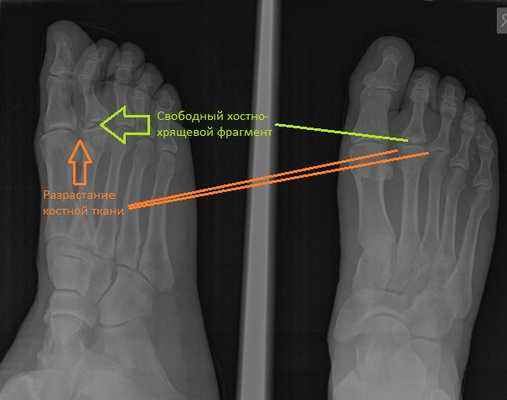 Болезнь Келлера 1 рентген
