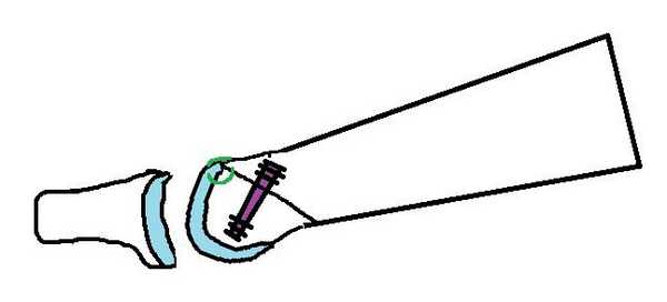 келлер 2 результат операции схема