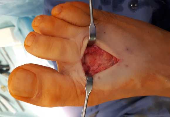 Болезнь Келлера 2 удаление экзостозов