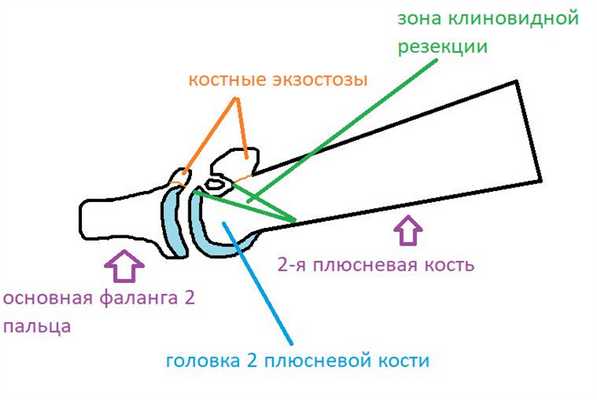 келлер 2 операция схема