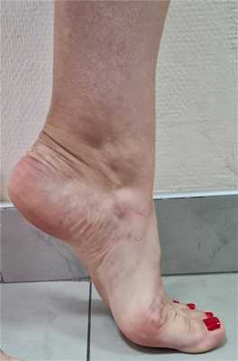 болезнь келлера 