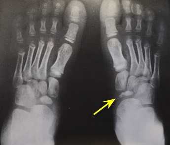 Болезнь Келлера 1